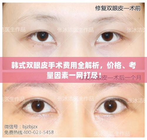 韓式雙眼皮手術(shù)費(fèi)用全解析，價(jià)格、考量因素一網(wǎng)打盡！