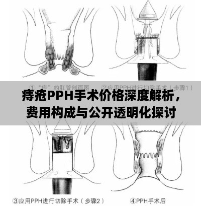 痔瘡PPH手術(shù)價格深度解析，費用構(gòu)成與公開透明化探討