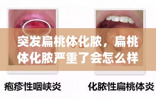 突發(fā)扁桃體化膿，扁桃體化膿嚴(yán)重了會(huì)怎么樣了 