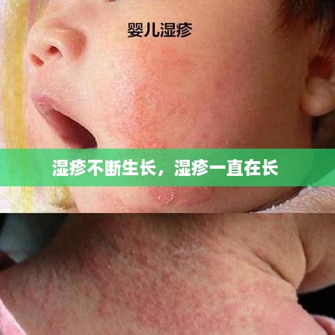 濕疹不斷生長，濕疹一直在長 